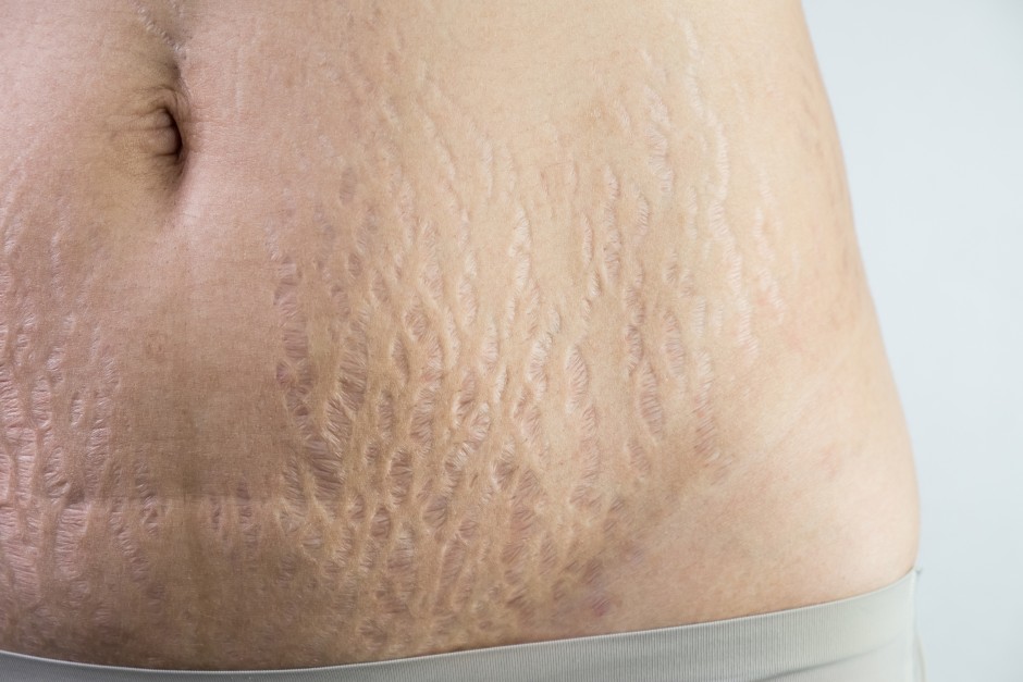 stretch mark reduction with microneedling New Westminster