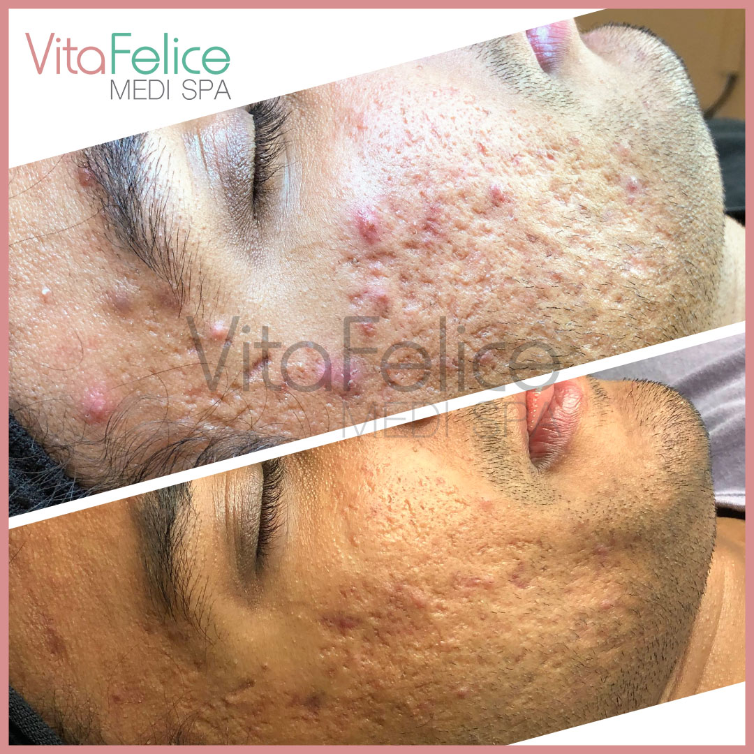 Acne-treatment-After-2-sessions-of-microneedling-in-New-Westminster