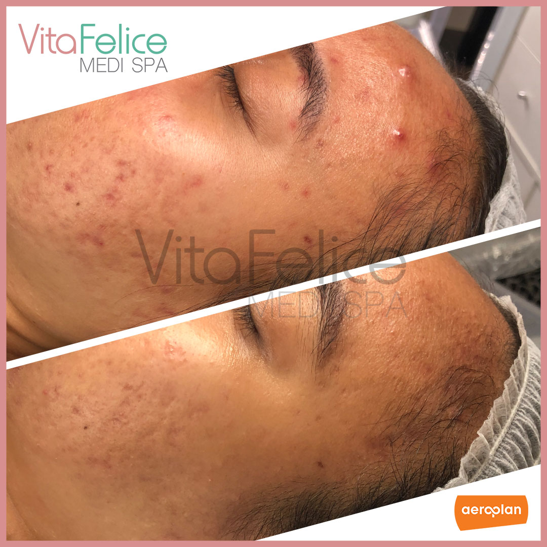 After one microneedling session at Vita Felice