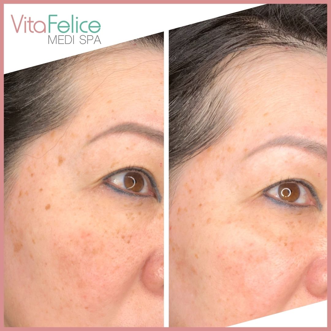Age-spots-removal-New-Westminster