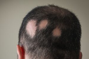 alopecia patients program
