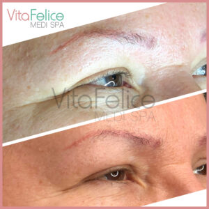 AnteAGE-Microneedling-LED New Westminster