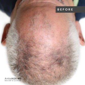 AnteAGE_MD-Hair__Before-After New Westminster