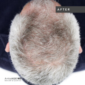AnteAGE_MD-Hair__Before-After_New Westminster_2