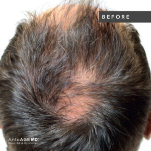 AnteAGE_MD-Hair__Before-After New Westminster 3