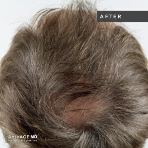 AnteAGE_MD-Hair__Before-After New Westminster 4