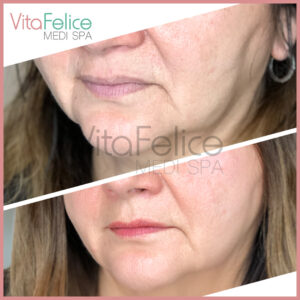 Microneedling-LED-in-New-Westminster