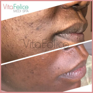 New-Westminster-acne-care