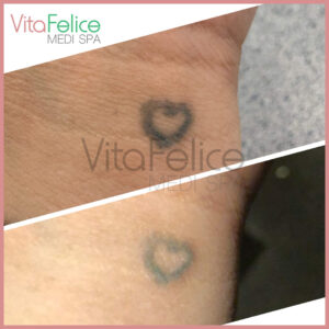 New-Westminster-tattoo-removal after 1 session