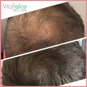 scalp micropigmentation for thinning hair New Westminster