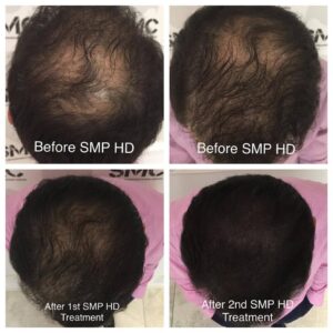 SMP-Density for thinning hair