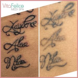 Saline Tattoo Removal In Progress New Westminster