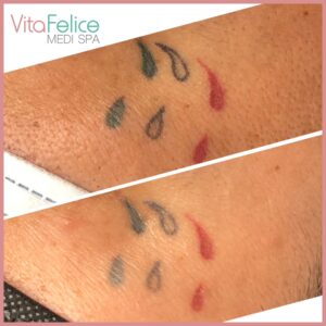 Saline-Tattoo-removal-after-two-sessions-New-Westminster