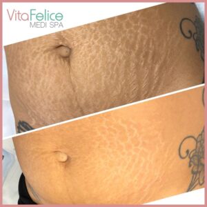 Stretch mark reduction New Westminster before after 2