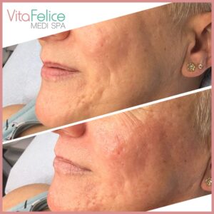 Sugaring-Facial-before-after-New-Westminster