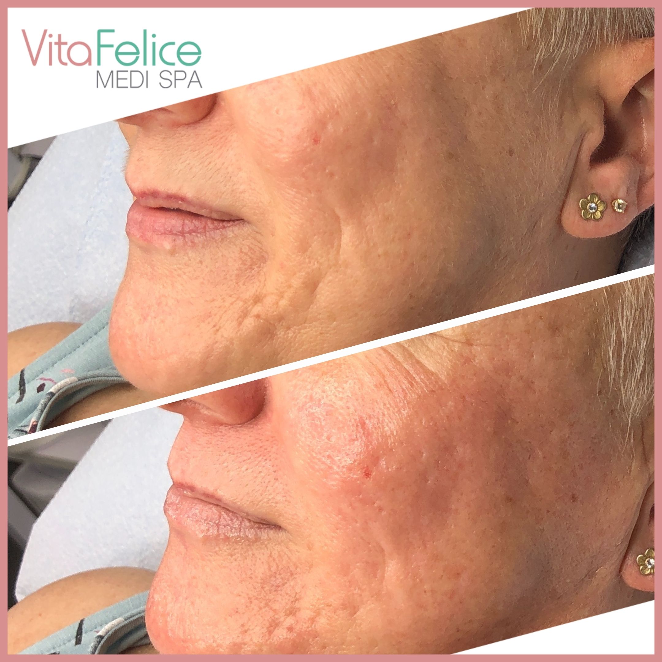 Sugaring-Facial-before-after-New-Westminster