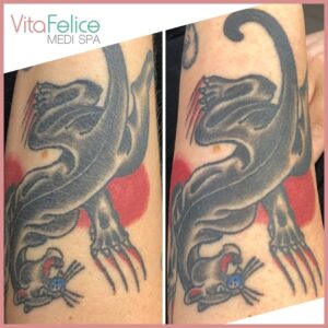 Sugaring over tattoo before after New Westminster (2)