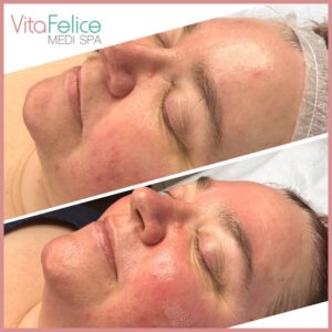 Sugaring facial New Westminster