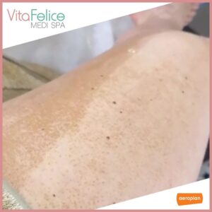 Sugaring-skin-exfoliation-Vita-Felice-New-Westminster