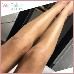 Summer ready legs after sugaring New Westminster
