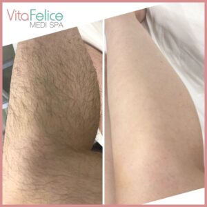 Summer ready legs before after sugaring New Westminster 2