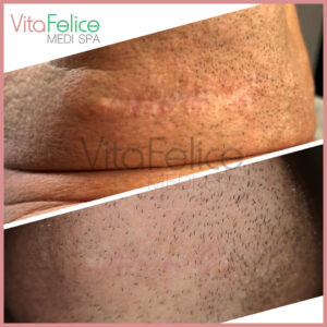 Scar reduction New Westminster