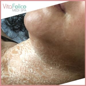 protein facial mask New Westminster