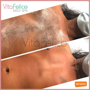 smooth-chest-after-sugaring-at-Vita-Felice-New-Westminster