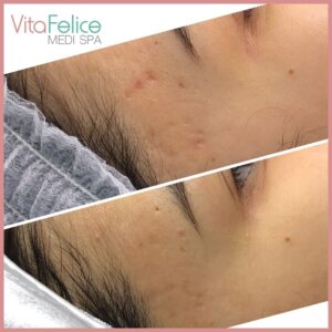 Acne Scar reduction on temple New Westminster before after