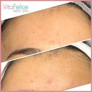 Acne scars after CIT (collagen Induction Therapy) New Westminster