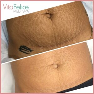 Microneedling on stretch mark New Westminster