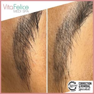Botched Ink Microblading removal after 1 session New Westminster