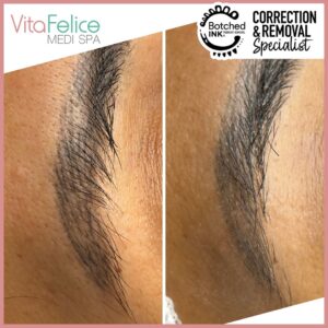 Microblading removal after 2 sessions of Botched Ink | New Westminster