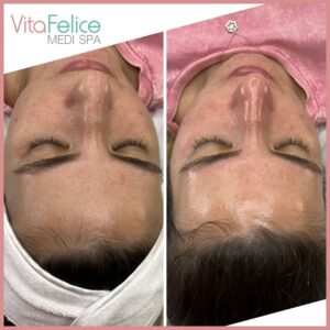 Peptide Chemical Peel New Westminster