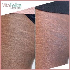 Stretch mark treatment after one session New Westminster