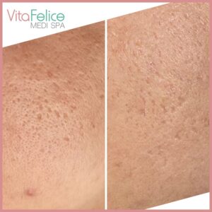 Acne scar reduction after 2 sessions of skin needling New Westminster, Metro Vancouver