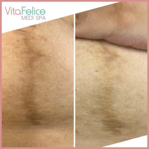 Breast Reduction Scar Treatment after 2 sessions of skin needling New Westminster, Metro Vancouver
