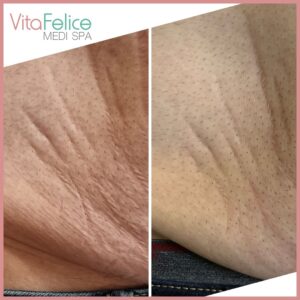 Stretch mark reduction after 2 sessions New Westminster, Metro Vancouver
