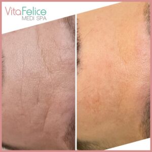 Wrinkle reduction after 2 skin needling sessions New Westminster, Metro Vancouver