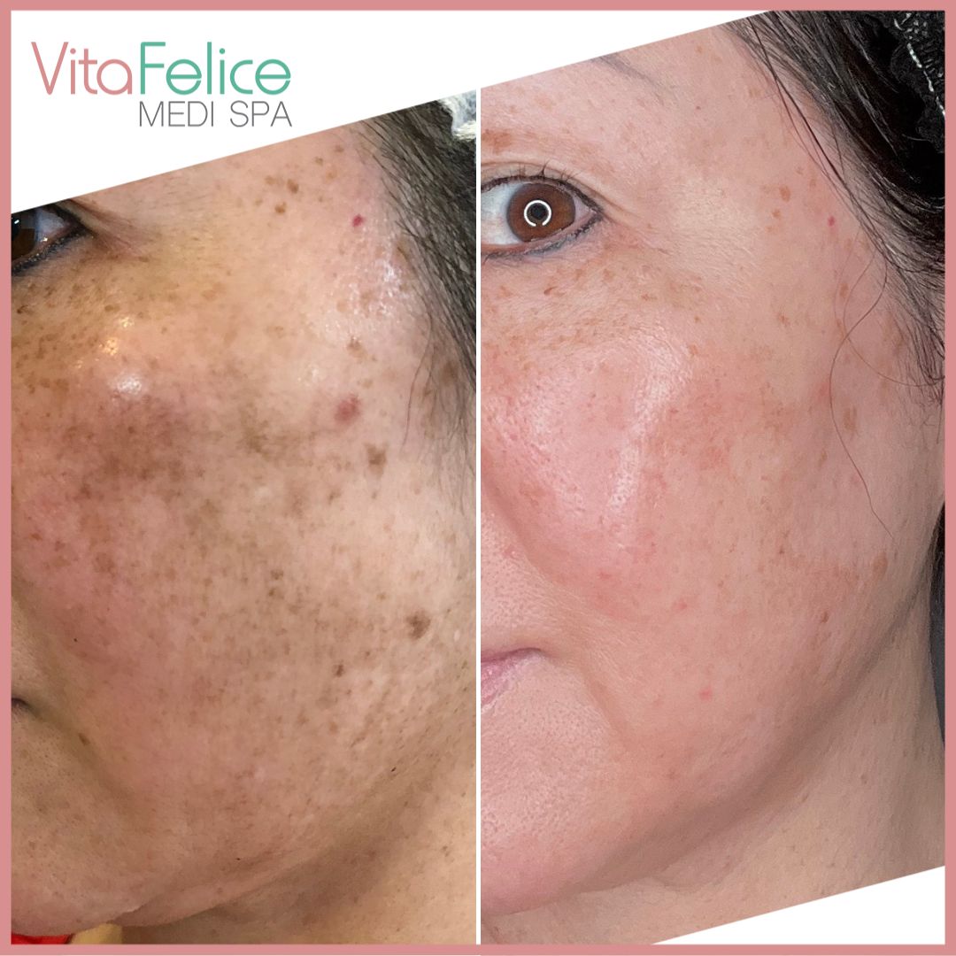 Pharmaceutical Grade Skin Treatment Before After New Westminster