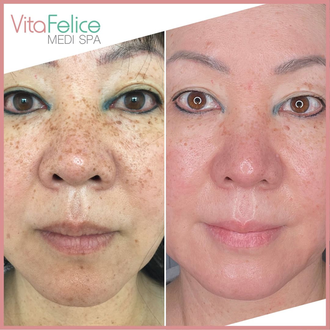 Pharmaceutical Grade Skin Treatment Before After New Westminster