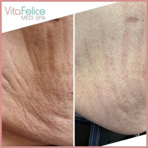 Stretch mark reduction after 3 sessions New Westminster