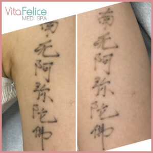 Saline Tattoo Removal after 3 sessions New Westminster