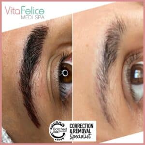 Emergency Microblading Removal after one session, New Westminster