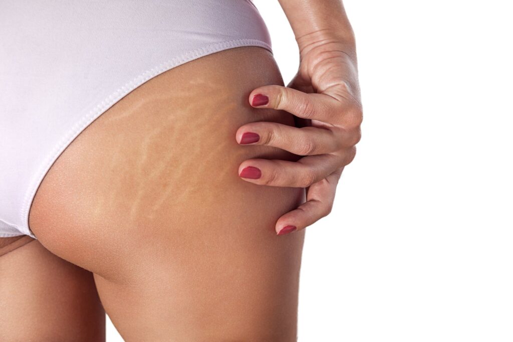 Stretch Marks: Red Vs. White. - Vancouver Permanent Makeup & Paramedical  Tattoos