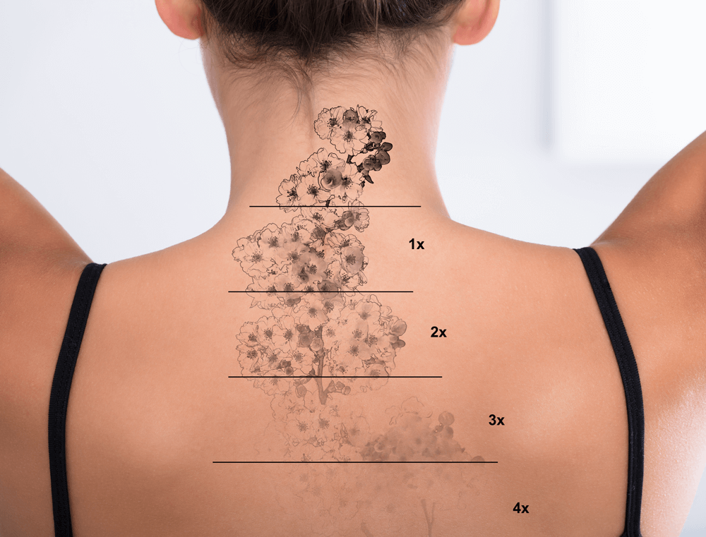 Laser Tattoo Removal Toronto | Laser Treatments