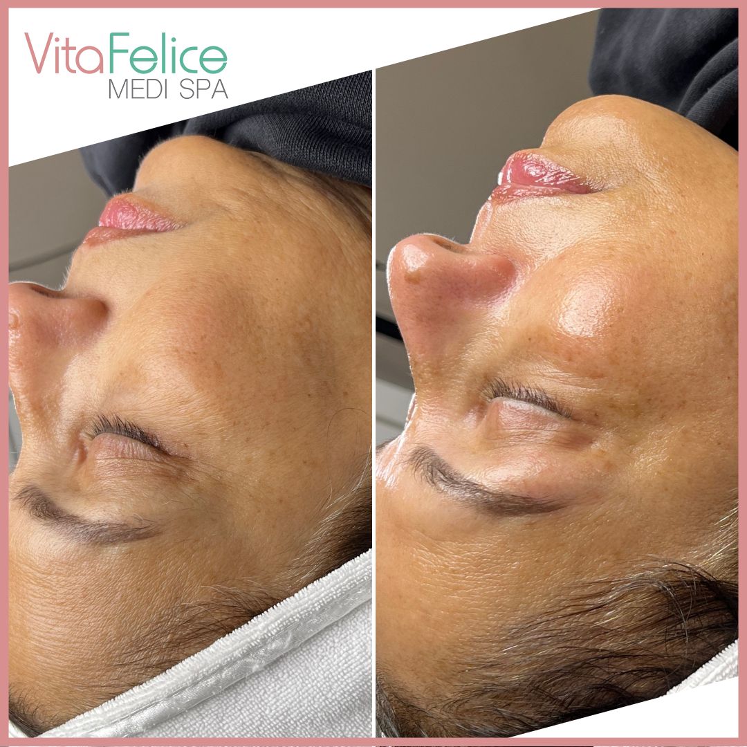 Sugaring Facial Before After New Westminster