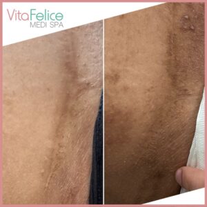 Burn-Scar-Treatment-Vancouver before and after 3 treatments