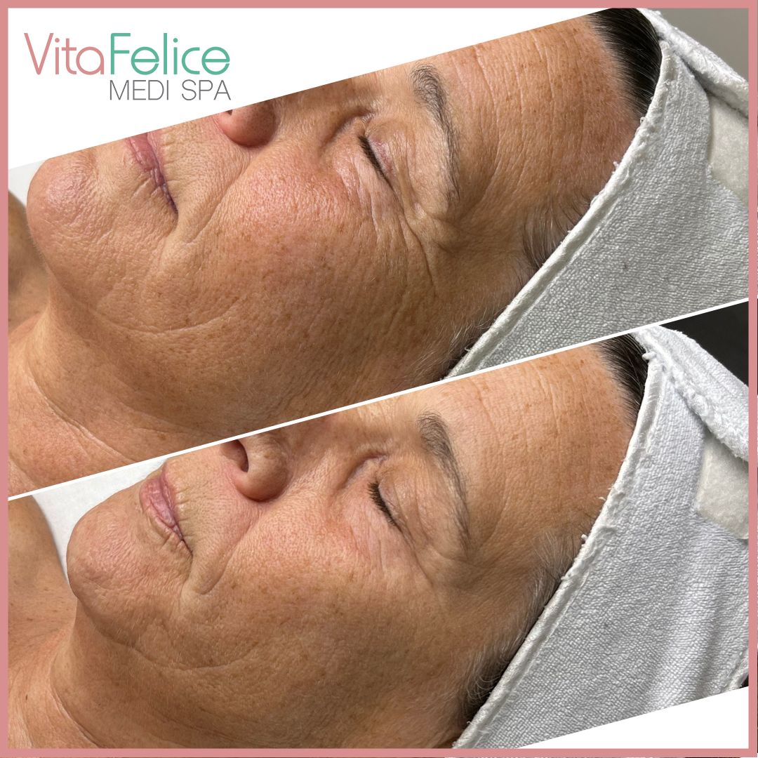 One facial and home care for 3 weeks before and after, Vita Felice in New Westminster