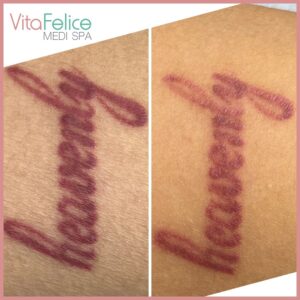 Saline Tattoo Removal after 1 session New Westminster